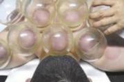 拔火罐间隔多长时间再拔