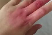 手指被烫伤了涂酱油有用吗 手指烫伤涂醋还是酱油