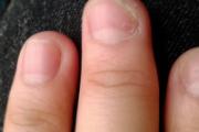 灰指甲是怎么形成的