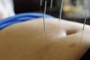 针灸减肥真的如此管用吗