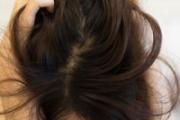 吃素治好了脂溢性脱发 脂溢性脱发会掉眉毛吗