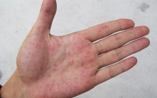 手脱皮最佳治疗方法,手脱皮怎么办,手脱皮怎么