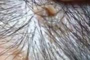 瘊子用头发绑多久会掉