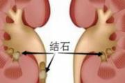 肾结石有什么症状 8点你要清楚