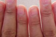 灰指甲反复发作折磨人怎么办 看完这些让你告别痛苦