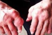 痛风人群适合吃什么 最适合痛风人的食谱大全
