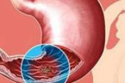 胃溃疡要怎样治疗 偏方食疗帮你养胃