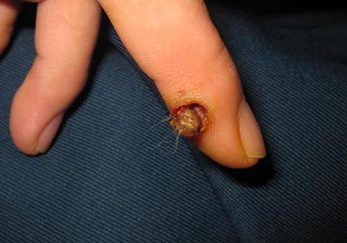 瘊子冷冻后起水泡怎么办,瘊子冷冻后水泡弄破会传染吗-乐哈健康网