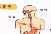 食道癌怎么检查出来的 食道癌分期标准