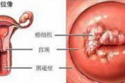 hpv病毒是什么