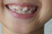 小孩换牙长歪了怎么办