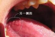 舌头下面长了个小肉什么原因