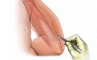 大便跟水一样喷射出来是怎么回事