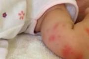 宝宝被蚊子叮了有疤自己会消吗 宝宝被蚊子咬怎么去疤