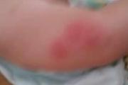 宝宝被蚊子咬后肿得很大怎么办