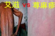 荨麻疹和艾滋病有关系吗