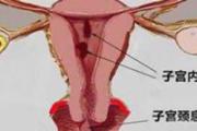 子宫息肉影响怀孕吗