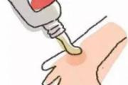 宝宝被蚊子叮了最快方法去红肿 宝宝被蚊子咬了怎么消肿止痒