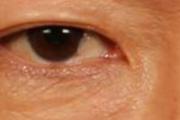 激光去眼袋多久恢复
