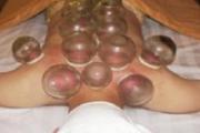 腰痛拔罐的位置图 腰痛拔罐有效果吗