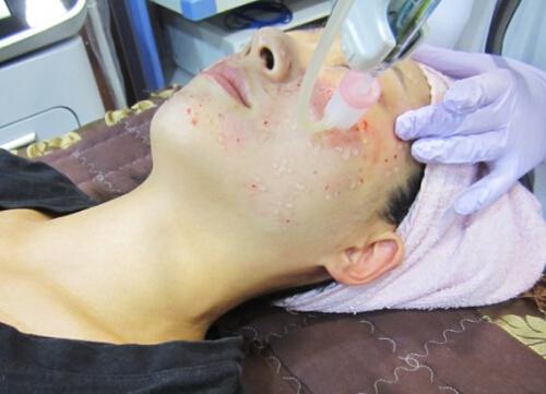 磨皮手术副作用