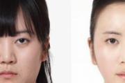 光子嫩肤后注意事项