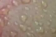 拔罐水泡是什么原因