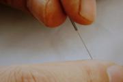 针灸减肥须知：4类人慎用针灸减肥