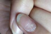 肝不好有什么症状 肝不好眼睛和手有这些症状