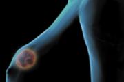 乳腺癌晚期症状