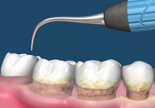 洗牙后的注意事项 洗牙后要注意什么 洗牙后应该注意什么 乐哈健康网