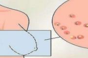 乳腺癌是一种什么样的病 乳腺癌发病的原因是什么