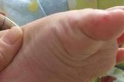 手足口病的预防措施 手足口病主要通过什么途径传播