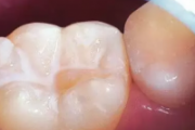 牙齿窝沟封闭是什么意思