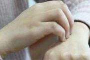 荨麻疹是什么引起的 荨麻疹的危害性