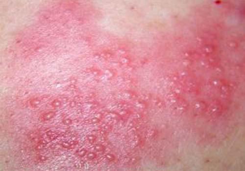 带状疱疹前期会出现很多不规则或2红斑神经疼痛为带状疱疹的初期症状