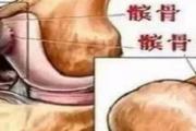 髌骨软化外用药有哪些 髌骨软化艾灸管用吗