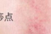 刮痧后背部颜色判断