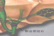 如何避免胆管结石 胆管结石脸会不会黄