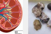 肾结石需要做手术吗