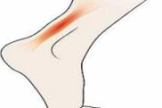 怎样区分跟腱炎和足底筋膜炎 跟腱炎拍片看的出来吗
