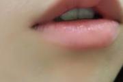 玻尿酸丰唇的危害