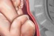 胎盘老化会提前生吗