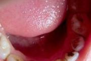牙髓炎是什么原因引起的