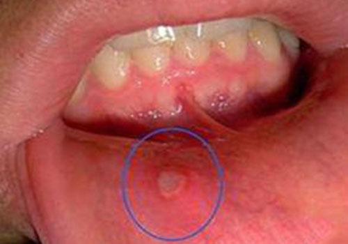 口腔溃疡虽然是菌类感染类的症状,但首先是要口腔黏膜出现损伤,若