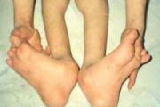 肌肉萎缩症是什么