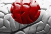 脑出血会有哪些症状 脑出血会出现8个信号