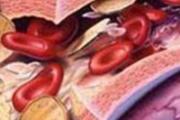 化血栓的食物有哪些 十秒防栓法