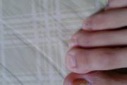 脚上灰指甲怎么治
