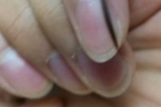 男人指甲有黑色竖纹 指甲黑色竖纹严重吗？怎么办？